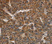 Immunohistochemistry of paraffin-embedded Human liver cancer using CAT Polyclonal Antibody at dilution of 1:40