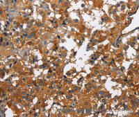 Immunohistochemistry of paraffin-embedded Human thyroid cancer tissue using CATSPER3 Polyclonal Antibody at dilution 1:60