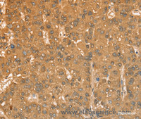 Immunohistochemistry of paraffin-embedded Human liver cancer tissue using CXCR4 Polyclonal Antibody at dilution 1:50