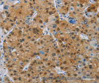 Immunohistochemistry of paraffin-embedded Human liver cancer tissue using CD272 Polyclonal Antibody at dilution 1:30