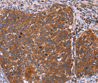 Immunohistochemistry of paraffin-embedded Human cervical cancer tissue using FBXW7 Polyclonal Antibody at dilution 1:40