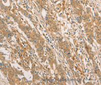 Immunohistochemistry of paraffin-embedded Human gastric cancer using CPB1 Polyclonal Antibody at dilution of 1:60