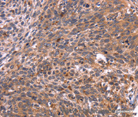 Immunohistochemistry of paraffin-embedded Human cervical cancer tissue using CRK Polyclonal Antibody at dilution 1:40