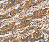 Immunohistochemistry of paraffin-embedded Human gastic cancer using CXCR6 Polyclonal Antibody at dilution of 1:30