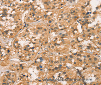 Immunohistochemistry of paraffin-embedded Human thyroid cancer using CXCR6 Polyclonal Antibody at dilution of 1:30
