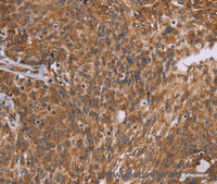 Immunohistochemistry of paraffin-embedded Human ovarian cancer using PPIB Polyclonal Antibody at dilution of 1:45