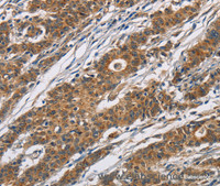 Immunohistochemistry of paraffin-embedded Human gasrtic cancer tissue using CYP21A2 Polyclonal Antibody at dilution 1:60