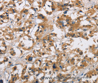 Immunohistochemistry of paraffin-embedded Human thyroid cancer tissue using CYP21A2 Polyclonal Antibody at dilution 1:60