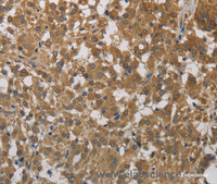 Immunohistochemistry of paraffin-embedded Human thyroid cancer using Cytochrome b5 Polyclonal Antibody at dilution of 1:40