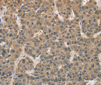 Immunohistochemistry of paraffin-embedded Human liver cancer tissue using DACH2 Polyclonal Antibody at dilution 1:40