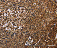 Immunohistochemistry of paraffin-embedded Human cervical cancer tissue using DCP1A Polyclonal Antibody at dilution 1:50