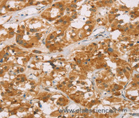 Immunohistochemistry of paraffin-embedded Human thyroid cancer tissue using DLL4 Polyclonal Antibody at dilution 1:40