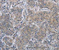 Immunohistochemistry of paraffin-embedded Human gastric cancer using DNAJB4 Polyclonal Antibody at dilution of 1:50