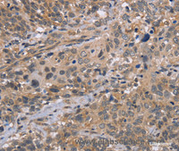 Immunohistochemistry of paraffin-embedded Human cervical cancer tissue using EDA Polyclonal Antibody at dilution 1:30