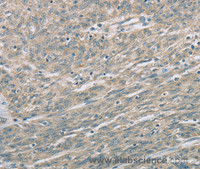 Immunohistochemistry of paraffin-embedded Human esophagus cancer using EDA2R Polyclonal Antibody at dilution of 1:60