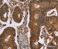 Immunohistochemistry of paraffin-embedded Human colon cancer tissue using FANCF Polyclonal Antibody at dilution 1:60