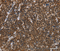 Immunohistochemistry of paraffin-embedded Human cervical cancer tissue using FASTKD2 Polyclonal Antibody at dilution 1:50