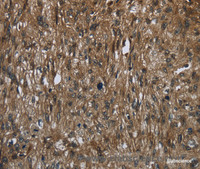 Immunohistochemistry of paraffin-embedded Human esophagus cancer tissue using FASTKD2 Polyclonal Antibody at dilution 1:50