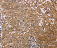 Immunohistochemistry of paraffin-embedded Human cervical cancer using FHL2 Polyclonal Antibody at dilution of 1:40