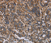 Immunohistochemistry of paraffin-embedded Human liver cancer using FLNA Polyclonal Antibody at dilution of 1:40