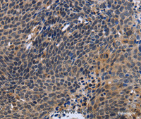 Immunohistochemistry of paraffin-embedded Human cervical cancer tissue using FSTL1 Polyclonal Antibody at dilution 1:30