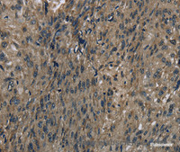 Immunohistochemistry of paraffin-embedded Human esophagus cancer using FTO Polyclonal Antibody at dilution of 1:60