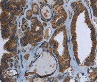 Immunohistochemistry of paraffin-embedded Human thyroid cancer using GCK Polyclonal Antibody at dilution of 1:40