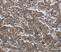 Immunohistochemistry of paraffin-embedded Human liver cancer using GGCX Polyclonal Antibody at dilution of 1:50