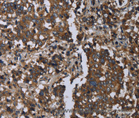 Immunohistochemistry of paraffin-embedded Human liver cancer using GOLGA2 Polyclonal Antibody at dilution of 1:60