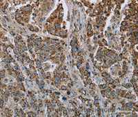 Immunohistochemistry of paraffin-embedded Human liver cancer using GOT2 Polyclonal Antibody at dilution of 1:50