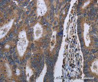 Immunohistochemistry of paraffin-embedded Human colon cancer using GSTA3 Polyclonal Antibody at dilution of 1:30