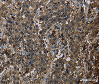 Immunohistochemistry of paraffin-embedded Human liver cancer using GSTA3 Polyclonal Antibody at dilution of 1:30