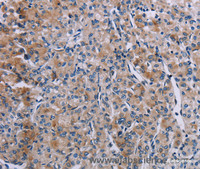 Immunohistochemistry of paraffin-embedded Human prostate cancer tissue using KDM4D Polyclonal Antibody at dilution 1:60