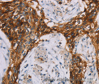 Immunohistochemistry of paraffin-embedded Human esophagus cancer using CD44 Polyclonal Antibody at dilution of 1:35