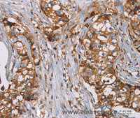 Immunohistochemistry of paraffin-embedded Human breast cancer using NDUFS1 Polyclonal Antibody at dilution of 1:50