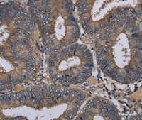 Immunohistochemistry of paraffin-embedded Human colon cancer tissue using NECTIN3 Polyclonal Antibody at dilution 1:40