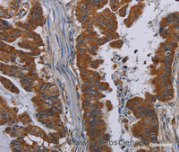 Immunohistochemistry of paraffin-embedded Human esophagus cancer tissue using NECTIN3 Polyclonal Antibody at dilution 1:40