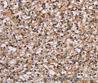 Immunohistochemistry of paraffin-embedded Human prostate cancer using NUP62 Polyclonal Antibody at dilution of 1:50