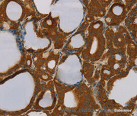 Immunohistochemistry of paraffin-embedded Human thyroid cancer tissue using PARP3 Polyclonal Antibody at dilution 1:40