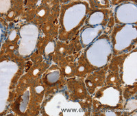 Immunohistochemistry of paraffin-embedded Human thyroid cancer using RAB27A Polyclonal Antibody at dilution of 1:30