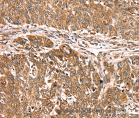 Immunohistochemistry of paraffin-embedded Human lung cancer using PDLIM4 Polyclonal Antibody at dilution of 1:30