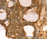 Immunohistochemistry of paraffin-embedded Human thyroid cancer using TAF11 Polyclonal Antibody at dilution of 1:40