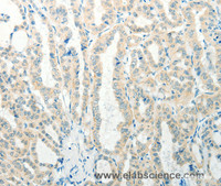 Immunohistochemistry of paraffin-embedded Human thyroid cancer tissue using RAB25 Polyclonal Antibody at dilution 1:50