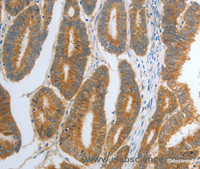 Immunohistochemistry of paraffin-embedded Human colon cancer tissue using RHEB Polyclonal Antibody at dilution 1:30