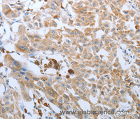 Immunohistochemistry of paraffin-embedded Human lung cancer tissue using FGF1 Polyclonal Antibody at dilution 1:50