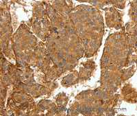 Immunohistochemistry of paraffin-embedded Human lung cancer tissue using COL4A1 Polyclonal Antibody at dilution 1:30