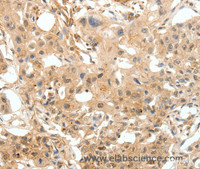 Immunohistochemistry of paraffin-embedded Human breast cancer tissue using COL4A1 Polyclonal Antibody at dilution 1:30