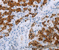 Immunohistochemistry of paraffin-embedded Human liver cancer tissue using NDUFA12 Polyclonal Antibody at dilution 1:50