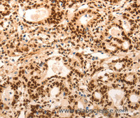 Immunohistochemistry of paraffin-embedded Human gasrtic cancer tissue using E2F7 Polyclonal Antibody at dilution 1:60