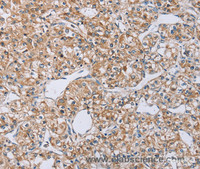 Immunohistochemistry of paraffin-embedded Human prostate cancer using EDA Polyclonal Antibody at dilution of 1:40